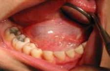 Dil Altı Tükürük Bezi İltihabı Belirtileri ve Tedavisi