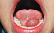 Tükürük Bezi Kisti Belirtileri ve Tedavisi