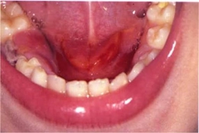 Tükürük Bezi Kanseri Belirtileri ve Tedavisi