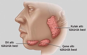 Yemek Yerken Tükürük Bezi Şişmesi
