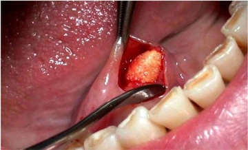 Dil Altı Tükürük Bezi Şişmesi