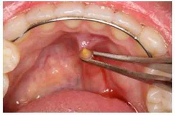 Tükürük Bezi Büyümesi Belirtileri ve Tedavisi